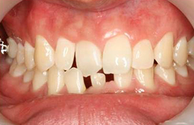 口腔颚机能恢复和交替治疗